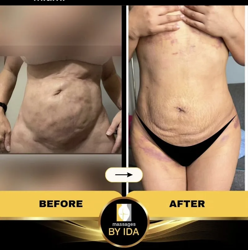 Lymphatic Massage By Ida Miami Fl