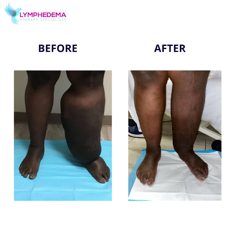 Lymphedema Therapy Specialists