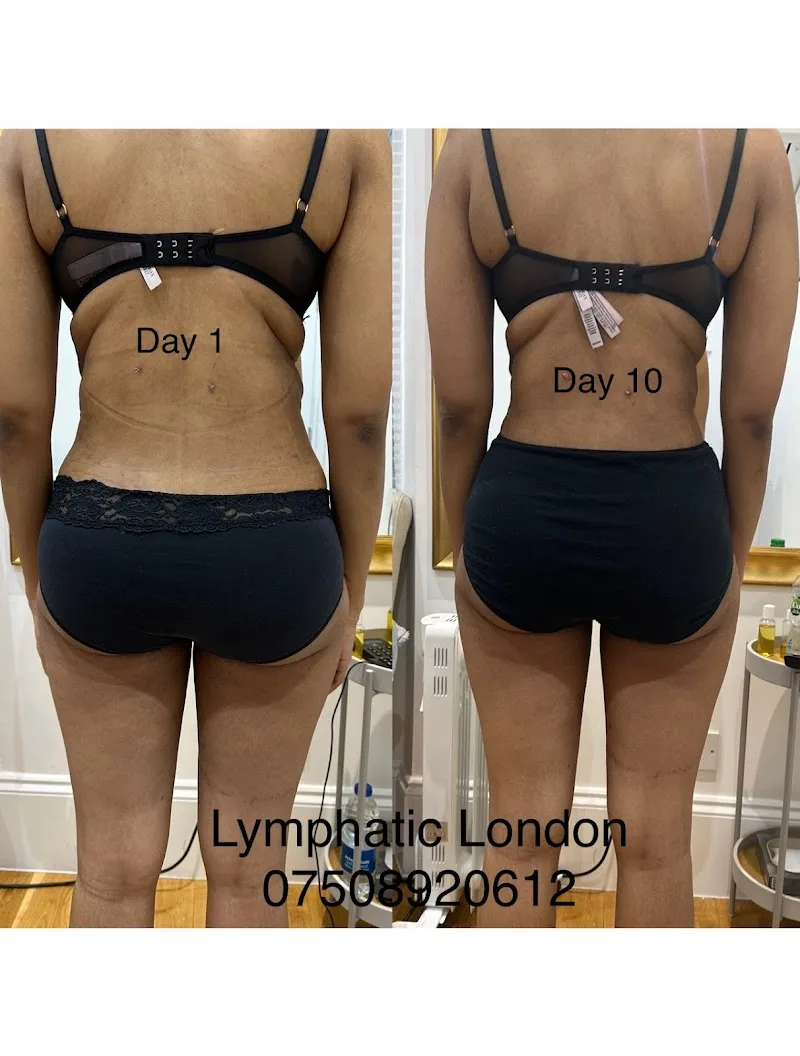 Lymphatic London
